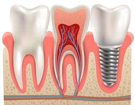 Dental Implants in Hyderabad, Secunderabad, and Malkajgiri | Virat Dental Clinic